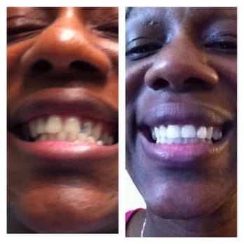California Smiles - Great job California Smiles - I got my smile back ! - General Dentistry Near Me - Long Beach, California California Smiles - Great job California Smiles - I got my smile back ! - General Dentistry Near Me - Long Beach, California