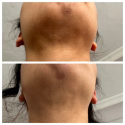 Bay Area Lymphatic & Post Lipo Massage - Chin lipo fibrosis treatment