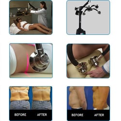 Millennium Med Spa - Zerona