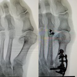 Seong Yoo, DPM - Painful bunion and hammer toe taken care of with the Lapidiplasty procedure and Weil for the hammer toe.