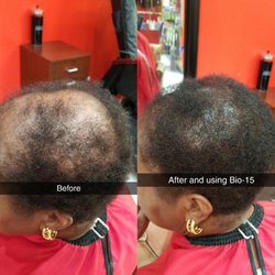 Boston Hair Studio - Hair loss treatment