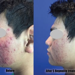 Clearwaves - No medications, no pain, no side-effects!