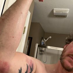 Bruises from being taken from my home by police