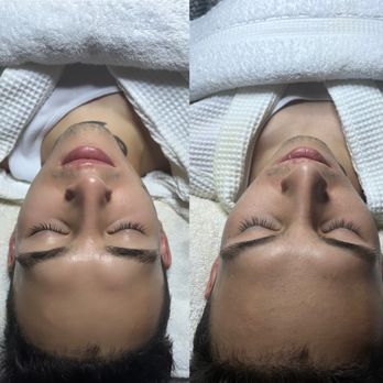 BBS Beauty Wellness - Before and after Hydration treatment book your appointment 562-832-0730 - Skin Care Near Me - Montebello, California BBS Beauty Wellness - Before and after Hydration treatment book your appointment 562-832-0730 - Skin Care Near Me - Montebello, California