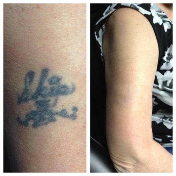 Disappearing inc. - Tattoo Removal Near Me - Framingham, Massachusetts Disappearing inc. - Tattoo Removal Near Me - Framingham, Massachusetts