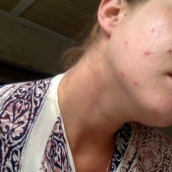 About Face Aesthetics - A week after my extractions - Skin Care Near Me - Philadelphia, Pennsylvania
