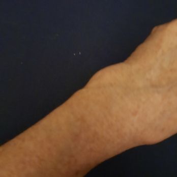 Chan Prince T MD - Deformed wrist due to Dr. Chan - Sports Medicine Near Me - Wichita, Kansas Chan Prince T MD - Deformed wrist due to Dr. Chan - Sports Medicine Near Me - Wichita, Kansas