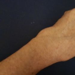 Chan Prince T MD - Deformed wrist due to Dr. Chan