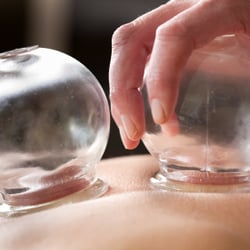 Acupuncture Vegas - Cupping