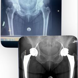 Stanford Orthopaedic Surgery - Before and after