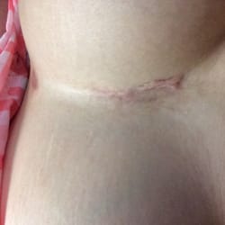 Kilo scars between my breasts ... I have to live with these cars for the rest my life because of what this doctor did.