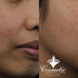Cosmetic Dermatology Center - Improved appearance of acne scars after a series of Microneedling treatments.
