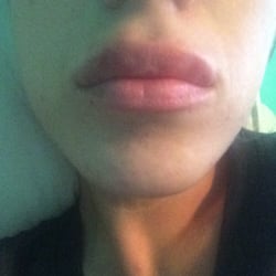 Kim Warren, RDH, CMM - Juvederm 3 days after. Still little bruised no pain and I loooove!