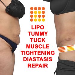 Pelosi Medical Center - Lipo 360, tummy tuck, muscle tightening diastasis repair.