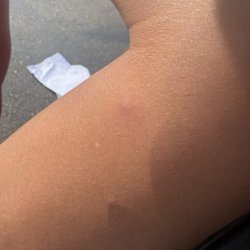 Holiday Inn Express - Bite mark on my daughter