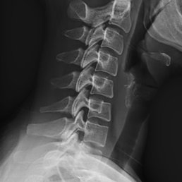 How my neck looked before the adjustments