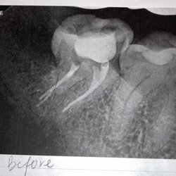 Northland Endodontics - What Kris did which is an unfinished and tarnished root canal