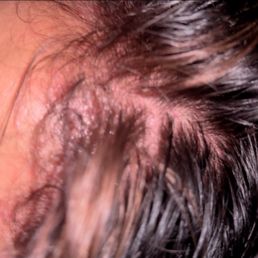 Allergic reaction after hair color, dont recommend!! Allergic reaction after hair color, dont recommend!!