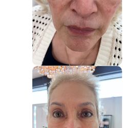 7 days after Radiesse