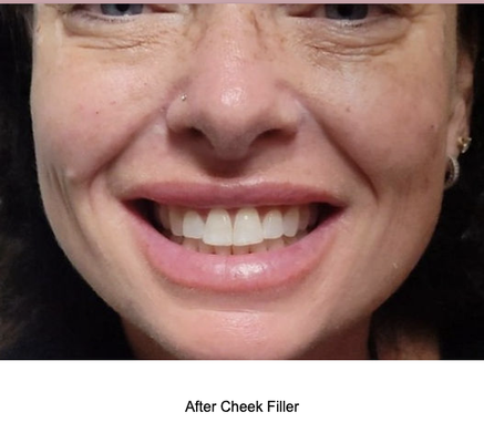 Cheek filler - Before & after. 1 syringe of filler.