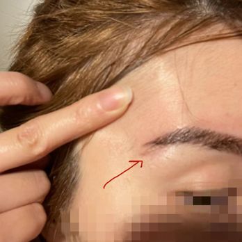 Arlington NOVA Laser & 3D Microblading - my face got cut - Eyebrow Services Near Me - Arlington, Virginia Arlington NOVA Laser & 3D Microblading - my face got cut - Eyebrow Services Near Me - Arlington, Virginia