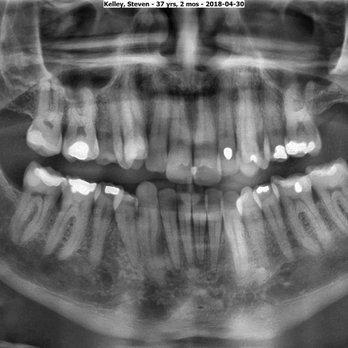 William D Nguyen, DDS MSD - This is what my teeth looked like prior to treatment and cant wait to post the after treatment photos in a couple years :) - Orthodontists Near Me - Monarch Beach, California William D Nguyen, DDS MSD - This is what my teeth looked like prior to treatment and cant wait to post the after treatment photos in a couple years :) - Orthodontists Near Me - Monarch Beach, California