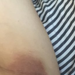 My underarm. It's all burned and super tender My underarm. It's all burned and super tender