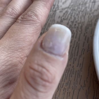 LipLash Organic Spa - Not sure if you can tell but there is a light green hue in the middle of my nail. It's definitely fungus that I didn't have before! - Eyelash Service Near Me - Ashburn, Virginia LipLash Organic Spa - Not sure if you can tell but there is a light green hue in the middle of my nail. It's definitely fungus that I didn't have before! - Eyelash Service Near Me - Ashburn, Virginia