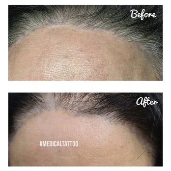 Pretty is Better - Facelift Scars Revision
Camouflages scars on the skin - they blend right in with your regular skin tone. - Permanent Makeup Near Me - Beverly Hills, California Pretty is Better - Facelift Scars Revision
Camouflages scars on the skin - they blend right in with your regular skin tone. - Permanent Makeup Near Me - Beverly Hills, California