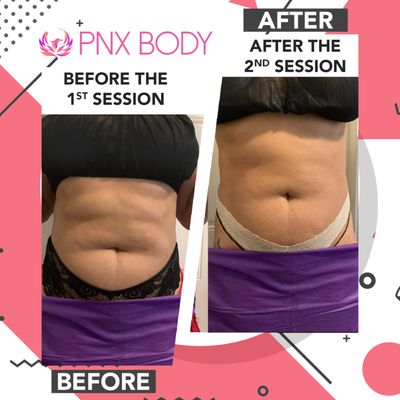 Shop All Fitness Wear & Supplements - PNX Body is your premiere center for noninvasive body sculpting. We offer body contouring treatments for men and women in Miami, Fort Lauderdale, and the neighboring communities of Florida.
Our body sculpting procedures in Miami and Wynwood help men and women get the body they desire when a balanced diet and regular exercise don’t seem to work. Body sculpting also called body contouring is a noninvasive massaging treatment with no downtime. It is used to remove fat cells and toxins from difficult areas of the body that store stubborn fat. The procedure is non-surgical and excludes the need for needles and anesthesia. Think of it as a nice relaxing warm massage that contours the body using Ultrasound, and Radio Frequency sculpting treatments. This helps to excrete fluids and toxins in specific areas like the hips, waist, buttocks, and abdomen through the Lymphatic drainage system.
Everyone is unique so I like to discuss the details of your body sculpting treatment in including the cost at the time of our one-on-one consultation. - Chantel
For your convenience, we offer multiple financing options to keep your treatments as affordable as possible.
Trusted by 100+ Customers
PNX BODY MIAMI | BODY CONTOURING WYNWOOD
WHAT BODY SCULPTING PROCEDURES ARE OFFERED IN MIAMI?
At PNX Body, we offer a variety of body sculpting treatments in Miami and Fort Lauderdale, including Ultrasonic Cavitation, Wood Therapy, Radio Frequency (RF), Body Wrapping, and Lymphatic Massages. Each body contouring procedure has its own benefits to help you get the results you desire.
Our staff uses a number of nonsurgical procedures to help decrease fat, tighten skin, and offer our patients an all-around revitalized, rejuvenated, and healthy look by using ultrasonic cavitation, infrared, radiofrequency, and sublative radiofrequency. The treatments last anywhere from 30 to 50 minutes and our patients are always pleased to experience no downtime. We can target and remove fat and areas of loose skin with the help of cutting-edge technology without causing any harm to neighboring tissue. After your treatment is over, you are free to return home and resume your regular activities. Even though you might see changes with just one session, many of our patients find that our recommended 3 – 4 treatments give them the results they desire. In the end, you'll have a slimmer and tighter figure. Some of the procedures we perform include:
Ultrasonic Cavitation
Ultrasonic cavitation is the use of ultrasound technology to break down fat cells below the skin. It is a non-surgical method of reducing cellulite and localized fat. The high-frequency sound waves produced by an ultrasonic cavitation machine are able to target and break down fats and cellulite, making them easier to eliminate from the body. One of the main benefits of ultrasonic cavitation is that it is a non-invasive alternative to surgery. There is no need for anesthesia or any type of incision, which means there is little to no downtime after treatment. Ultrasonic cavitation is also much more affordable than surgery, making it a more accessible option for those looking to reduce fat and cellulite. While there are many benefits to ultrasonic cavitation, it's important to note that results vary from person to person. Some people may see significant results after just one treatment, while others may require multiple treatments before seeing any noticeable difference.
Radiofrequency Skin Tightening
A youthful appearance is something that many people in Miami, Fort Lauderdale, and surrounding areas in Florida really desire. People prefer to have skin that is less wrinkled, smoother, has less cellulite, and has firmer body contours. But it takes time to repair your skin to its youthful state. You may save time, get the best results, and maintain an active lifestyle with simple, quick, painless aesthetic treatments performed by PNX Body using the latest RF technology. The skin's subdermal layer is the target of radiofrequency thermal energy, which is used to promote the body's own healing mechanisms. The stimulation causes protein and collagen to start rebuilding right away, giving the treated area's skin a tighter, firmer appearance.
Radio Frequency is also appropriate for body reshaping and tightening procedures. These procedures have been more and more popular in recent years, and we are now encountering an increase in the number of patients looking for a non-invasive method to tighten their loose skin and reduce cellulite for a more toned overall appearance. The non-invasive body treatment technology from PNX Body offers greater collagen remodeling along with deeper, regulated, and targeted RF energy penetration that tightens and shapes for better, safer, and more comfortable treatments.
Smoother, wrinkle-free, more attractive skin visible quickly
It is a non-invasive procedure with no discomfort
Capable of working on small or large parts of the body
BOOK A FREE CONSULTATION TODAY Shop All Fitness Wear & Supplements - PNX Body is your premiere center for noninvasive body sculpting. We offer body contouring treatments for men and women in Miami, Fort Lauderdale, and the neighboring communities of Florida.
Our body sculpting procedures in Miami and Wynwood help men and women get the body they desire when a balanced diet and regular exercise don’t seem to work. Body sculpting also called body contouring is a noninvasive massaging treatment with no downtime. It is used to remove fat cells and toxins from difficult areas of the body that store stubborn fat. The procedure is non-surgical and excludes the need for needles and anesthesia. Think of it as a nice relaxing warm massage that contours the body using Ultrasound, and Radio Frequency sculpting treatments. This helps to excrete fluids and toxins in specific areas like the hips, waist, buttocks, and abdomen through the Lymphatic drainage system.
Everyone is unique so I like to discuss the details of your body sculpting treatment in including the cost at the time of our one-on-one consultation. - Chantel
For your convenience, we offer multiple financing options to keep your treatments as affordable as possible.
Trusted by 100+ Customers
PNX BODY MIAMI | BODY CONTOURING WYNWOOD
WHAT BODY SCULPTING PROCEDURES ARE OFFERED IN MIAMI?
At PNX Body, we offer a variety of body sculpting treatments in Miami and Fort Lauderdale, including Ultrasonic Cavitation, Wood Therapy, Radio Frequency (RF), Body Wrapping, and Lymphatic Massages. Each body contouring procedure has its own benefits to help you get the results you desire.
Our staff uses a number of nonsurgical procedures to help decrease fat, tighten skin, and offer our patients an all-around revitalized, rejuvenated, and healthy look by using ultrasonic cavitation, infrared, radiofrequency, and sublative radiofrequency. The treatments last anywhere from 30 to 50 minutes and our patients are always pleased to experience no downtime. We can target and remove fat and areas of loose skin with the help of cutting-edge technology without causing any harm to neighboring tissue. After your treatment is over, you are free to return home and resume your regular activities. Even though you might see changes with just one session, many of our patients find that our recommended 3 – 4 treatments give them the results they desire. In the end, you'll have a slimmer and tighter figure. Some of the procedures we perform include:
Ultrasonic Cavitation
Ultrasonic cavitation is the use of ultrasound technology to break down fat cells below the skin. It is a non-surgical method of reducing cellulite and localized fat. The high-frequency sound waves produced by an ultrasonic cavitation machine are able to target and break down fats and cellulite, making them easier to eliminate from the body. One of the main benefits of ultrasonic cavitation is that it is a non-invasive alternative to surgery. There is no need for anesthesia or any type of incision, which means there is little to no downtime after treatment. Ultrasonic cavitation is also much more affordable than surgery, making it a more accessible option for those looking to reduce fat and cellulite. While there are many benefits to ultrasonic cavitation, it's important to note that results vary from person to person. Some people may see significant results after just one treatment, while others may require multiple treatments before seeing any noticeable difference.
Radiofrequency Skin Tightening
A youthful appearance is something that many people in Miami, Fort Lauderdale, and surrounding areas in Florida really desire. People prefer to have skin that is less wrinkled, smoother, has less cellulite, and has firmer body contours. But it takes time to repair your skin to its youthful state. You may save time, get the best results, and maintain an active lifestyle with simple, quick, painless aesthetic treatments performed by PNX Body using the latest RF technology. The skin's subdermal layer is the target of radiofrequency thermal energy, which is used to promote the body's own healing mechanisms. The stimulation causes protein and collagen to start rebuilding right away, giving the treated area's skin a tighter, firmer appearance.
Radio Frequency is also appropriate for body reshaping and tightening procedures. These procedures have been more and more popular in recent years, and we are now encountering an increase in the number of patients looking for a non-invasive method to tighten their loose skin and reduce cellulite for a more toned overall appearance. The non-invasive body treatment technology from PNX Body offers greater collagen remodeling along with deeper, regulated, and targeted RF energy penetration that tightens and shapes for better, safer, and more comfortable treatments.
Smoother, wrinkle-free, more attractive skin visible quickly
It is a non-invasive procedure with no discomfort
Capable of working on small or large parts of the body
BOOK A FREE CONSULTATION TODAY