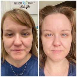 Before and a few days after microneedling.