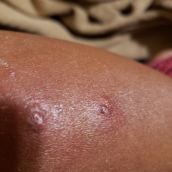 Hyatt Place Sumter / Downtown - Bed Bug Bite #1 - Hotels Near Me - Sumter, South Carolina Hyatt Place Sumter / Downtown - Bed Bug Bite #1 - Hotels Near Me - Sumter, South Carolina