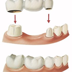 Premier Dental Center Seguin - A bridge is a fixed dental restoration used to replace a missing tooth by joining an artificial tooth permanently to adjacent teeth.