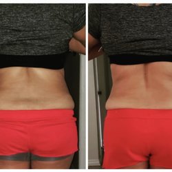 Anjelic Touch - Non Invasive treatment