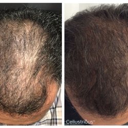Cellustrious Hair Rejuvenation - Before and after 5 treatments