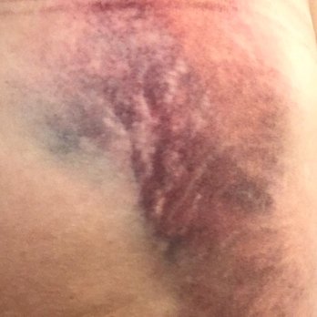 Masri Medical - My hip 3 days after falling. I was NOT lying for pain pills. - Family Practice Near Me - Apopka, Florida