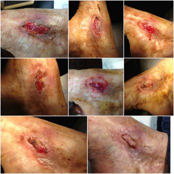 Leonard Greenwald, DPM - WOUND CARE PROGRESS ON A WEEKLY BASIS UNTIL CLOSED - Podiatrists Near Me - San Jose, California