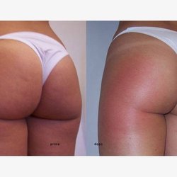 T&N Estetica Avanzata - Come potete vedere dalle foto il risultato è garantito