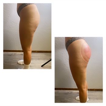 Levels To Skin - Book Butt Enhancement!
Client details: 1 session
For lasting results you need a 4-8 sessions. - Aestheticians Near Me - Citrus Heights, California Levels To Skin - Book Butt Enhancement!
Client details: 1 session
For lasting results you need a 4-8 sessions. - Aestheticians Near Me - Citrus Heights, California