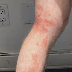 Janet Vafaie, MD, FAAD - Before Sonafine Wound Dressing cream