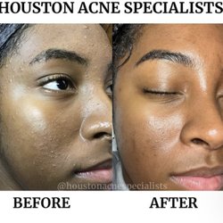 Houston Acne Specialists
