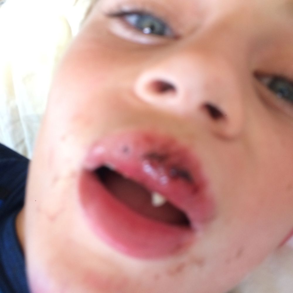 Global Dental Care - Charlie before. - Dentists Near Me - Silver Spring, Maryland