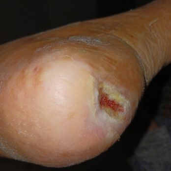 Advanced Surgical Care - Heel ulcer from blockage of vessels - Surgeons Near Me - Reno, Nevada