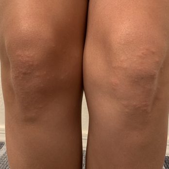 ParcLand Crossing Apartments - Rash from crawling after baby (month old) - Apartments Near Me - Chandler, Arizona ParcLand Crossing Apartments - Rash from crawling after baby (month old) - Apartments Near Me - Chandler, Arizona