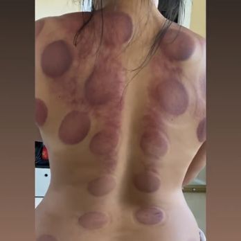 Holt Fit Performance Recovery Center - Cupping and scrapping. Releasing all the tension - Massage Therapy Near Me - Aiea, Hawaii Holt Fit Performance Recovery Center - Cupping and scrapping. Releasing all the tension - Massage Therapy Near Me - Aiea, Hawaii