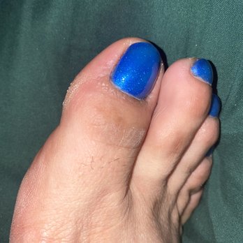D - Luxe Nails Studio - The disgusting bumps of the infection - Nail Salons Near Me - Moreno Valley, California