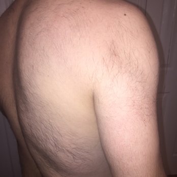 The Laser Spot - I never ever had hair on my shoulders like this before!! after she shaved my shoulders this is what happened!!! - Laser Hair Removal Near Me - Huntington, New York The Laser Spot - I never ever had hair on my shoulders like this before!! after she shaved my shoulders this is what happened!!! - Laser Hair Removal Near Me - Huntington, New York