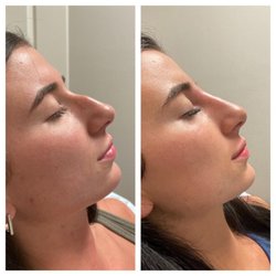 Shining Way Esthetics - Liquid Nose Job. "Liquid Rhinoplasty."