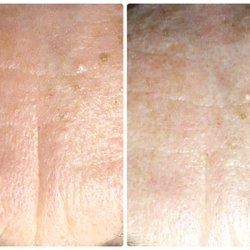 Deep set wrinkle & fine line reduction with regular Facelift Facials.
NO BOTOX OR FILLER & SAME FACIAL EXPRESSION!