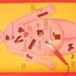 Royal Victoria Infirmary - Actual photograph of an operation.